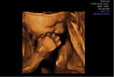 Schwangerschaft 3d 4d Ultraschall